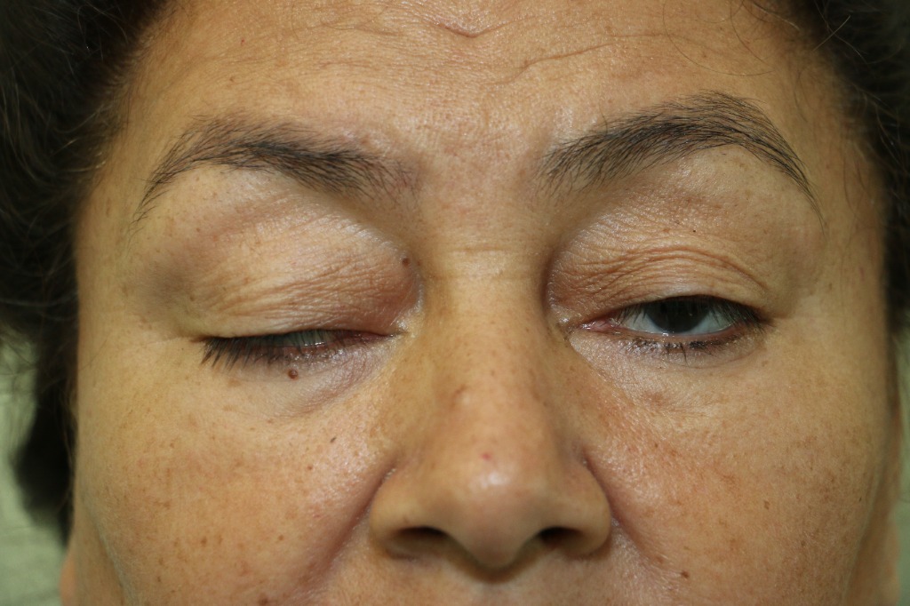 Blefaroptosis en adulto - Antes