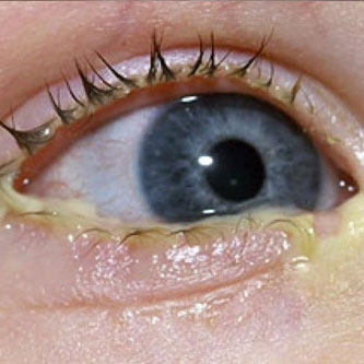 LagrimalCongenita2